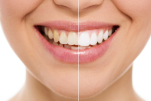 close up before and after photo of white teeth