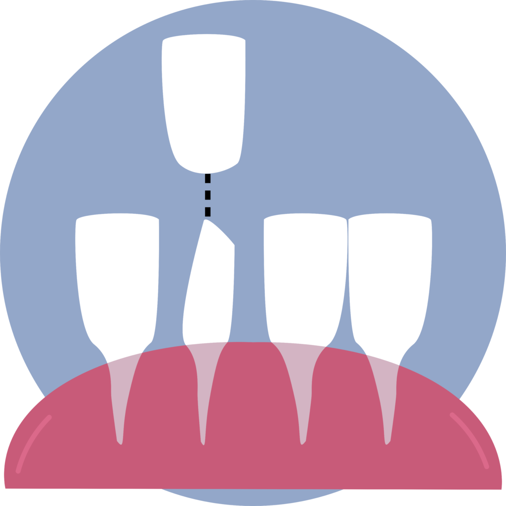 How Can Tooth Bonding Help You?