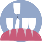 bonding teeth vs other options