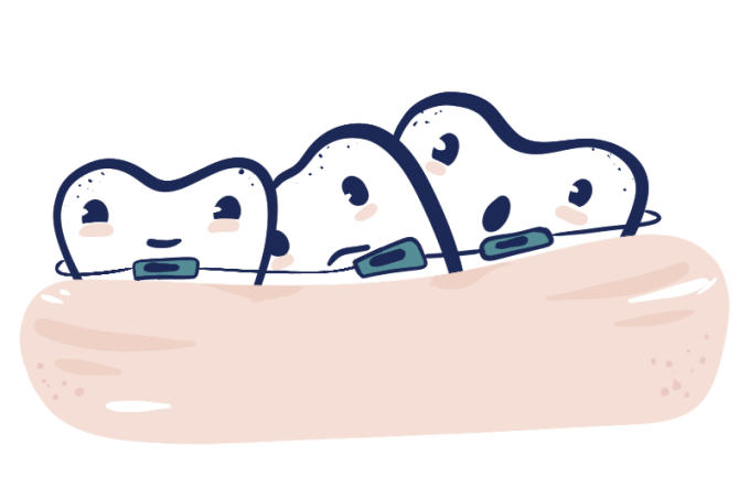Cartoon illustration of three misaligned teeth wrapped with wire and metal brackets to represent the tooth straightening process with traditional braces.