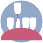 Dental Tooth Bonding