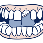 Dental Emergencies with Permanent Teeth