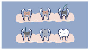 Illustration answering the question "what is a root canal?" with images of teeth at different stages of the procedure.