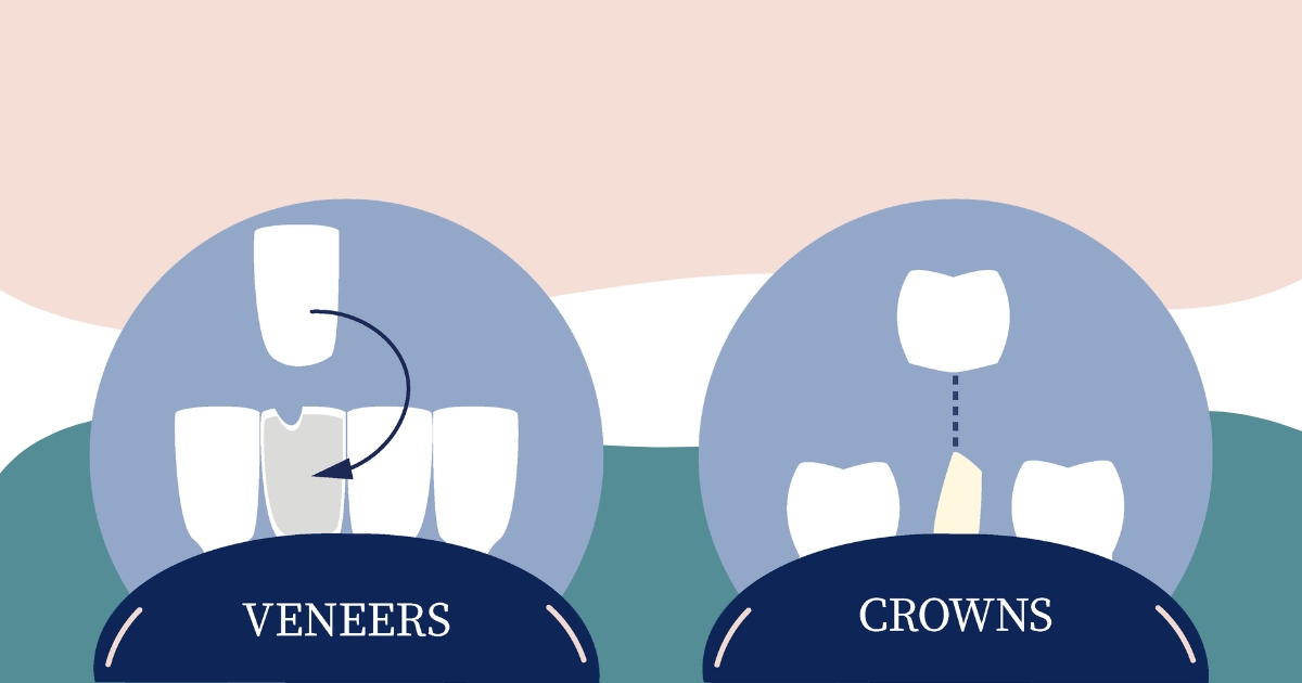 Veneers vs Crown Graphic