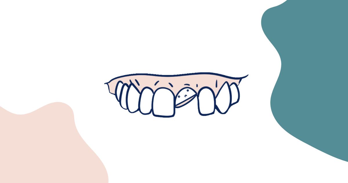 Icon of broken teeth. Digital Dentures vs Traditional