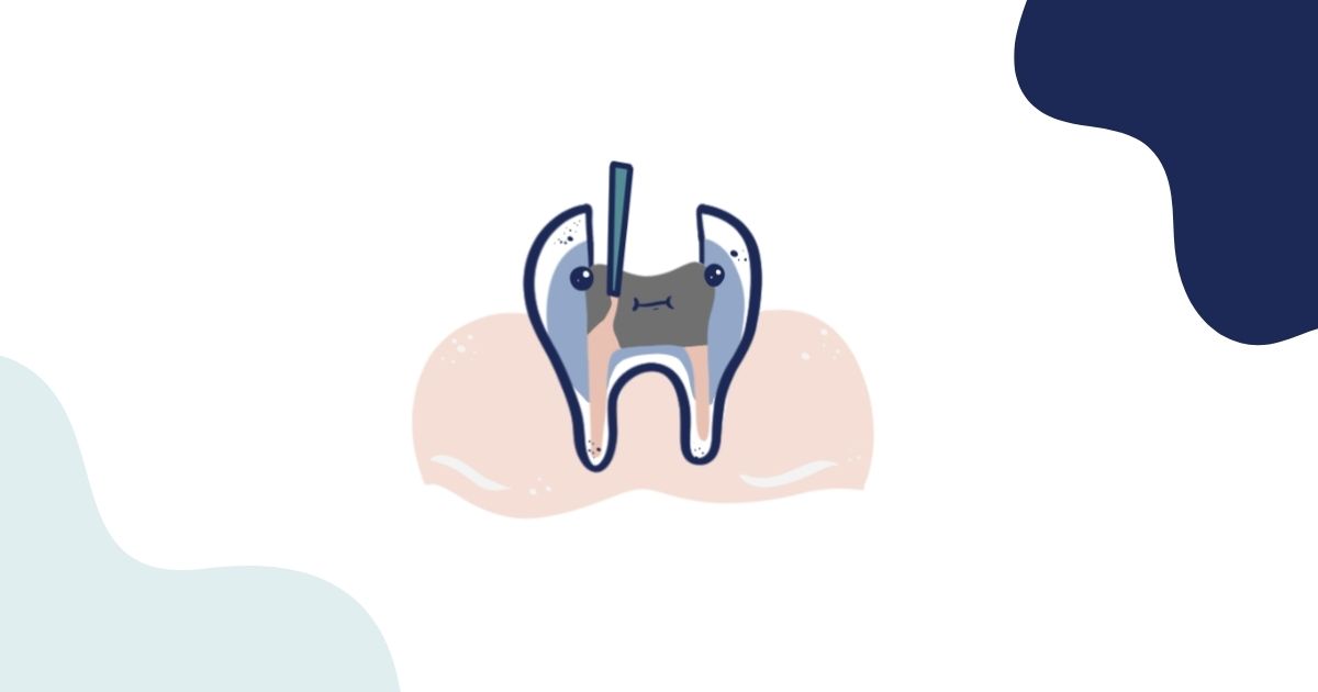 Illustration of a dental filling procedure, showing a cross-section of a tooth with a cavity being treated. A dental tool is inserted to clean the decay before placing the filling material, highlighting the process of restoring a damaged tooth.