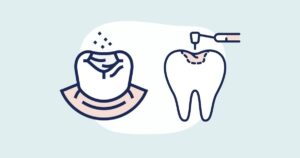 Illustration comparing dental sealants vs fillings: on the left, a tooth with protective sealant application, and on the right, a tooth showing decay being drilled for a filling, highlighting the preventative benefits of sealants versus restorative fillings.