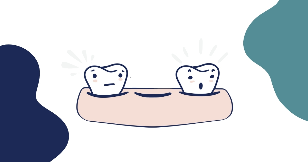 Illustration of two surprised teeth on either side of an empty gum space, symbolizing tooth avulsion and a knocked out tooth scenario, often requiring urgent dental care.